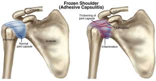 Frozen shoulder, adhesive capsulitis, دکتر حسین ارجمند, چسبندگی مفصل شانه